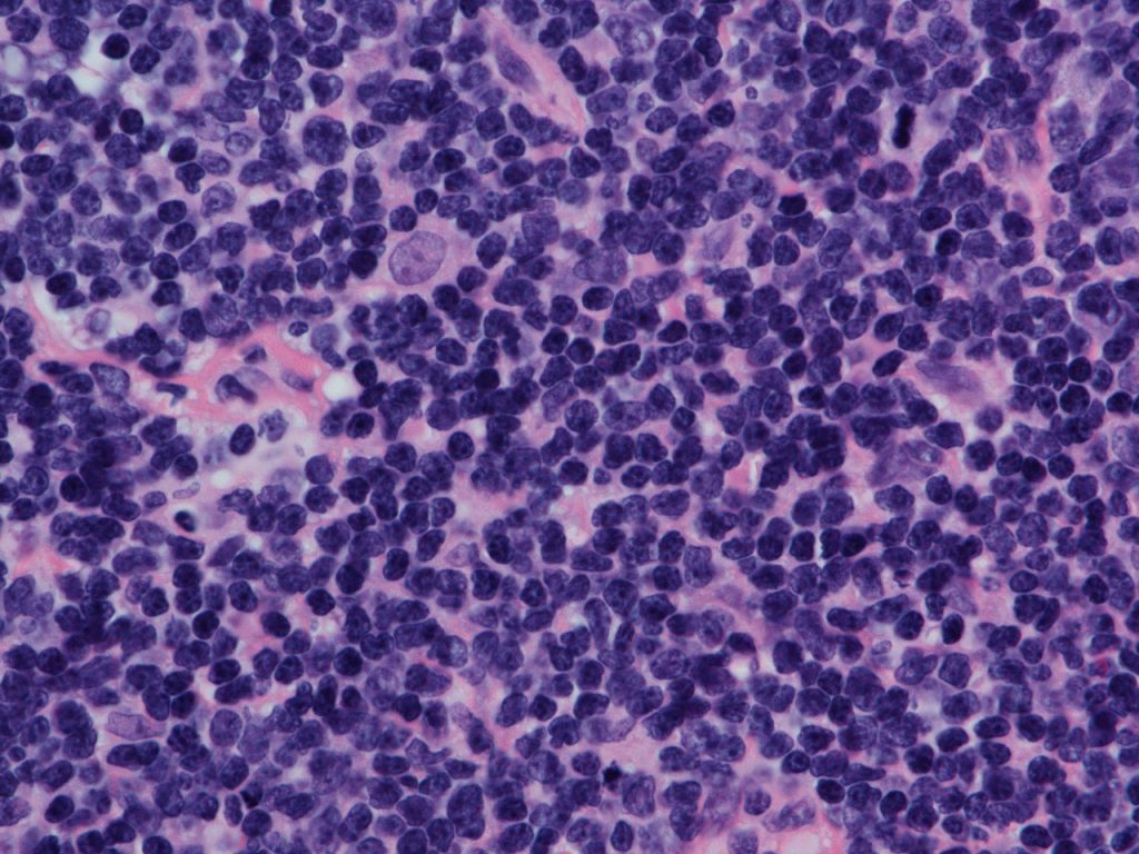 Linfoma Não Hodgkin
