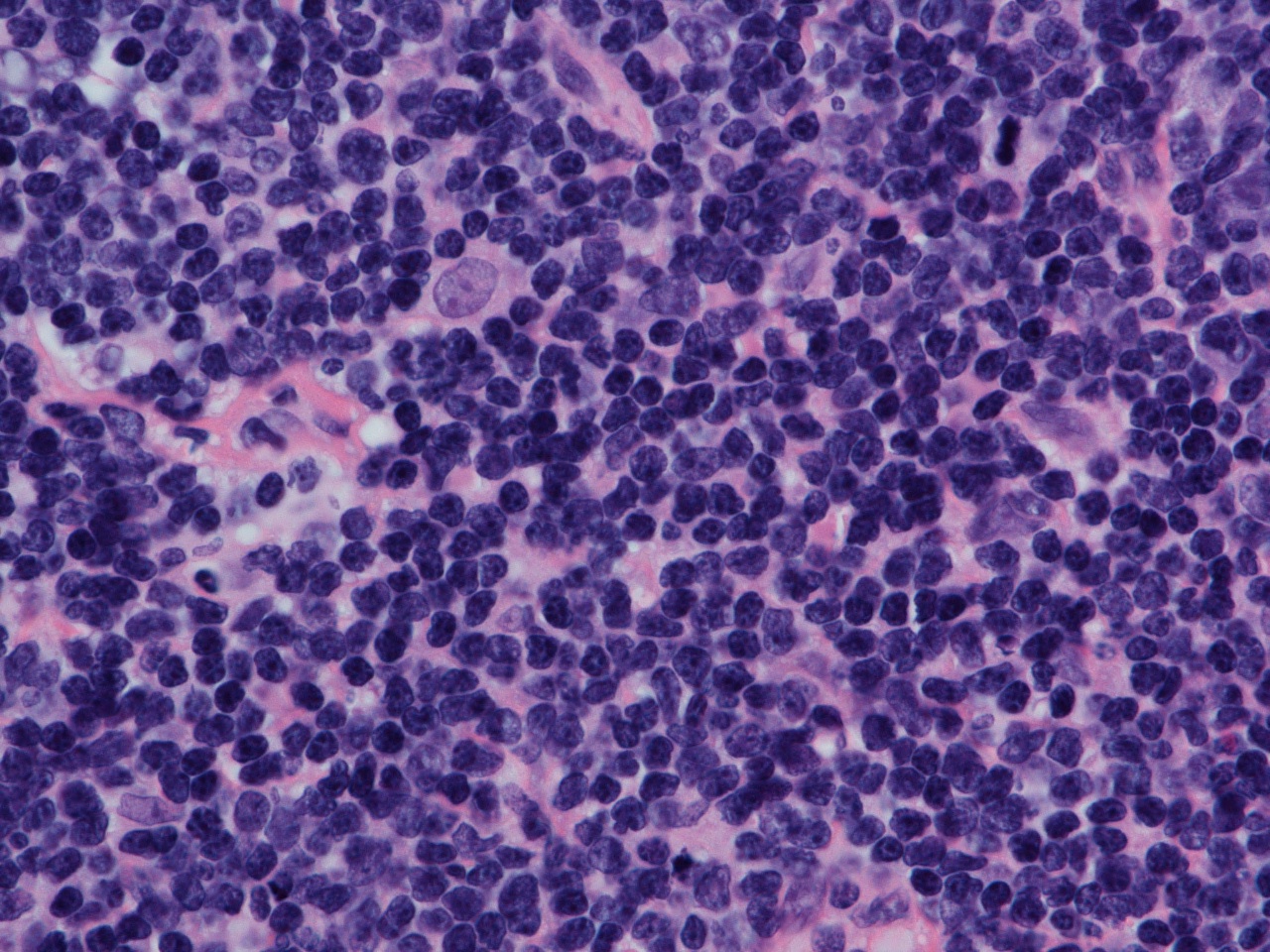 Linfoma Não Hodgkin