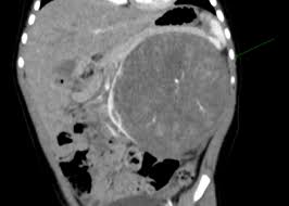 Tumor de Wilms