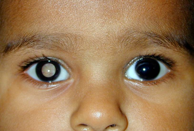 Retinoblastoma